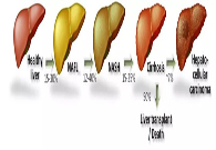 談肝色變肝病NASH的探索之路