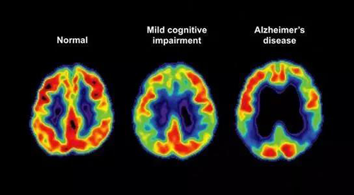 阿爾茨海默氏症是一種由腦細胞逐漸退化引起的神經退行性疾病