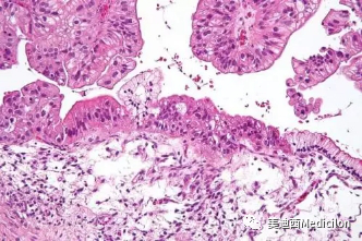 低度惡性(LMP)卵巢粘液性腫瘤的顯微鏡照片