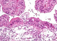 【Science速遞】“沉默的殺手”卵巢癌的治療新靶點終於被發現了