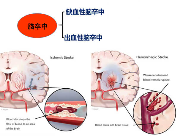 1-腦中風主要有缺血性中風和出血性腦卒中.jpg