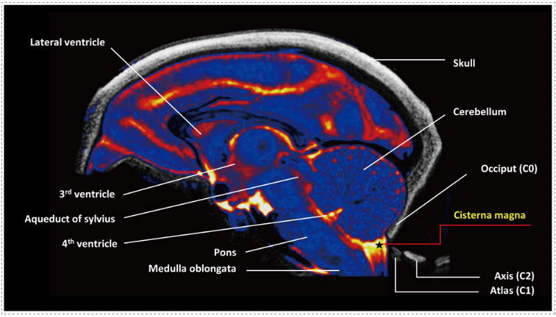 猴腦中小腦延髓池-(CM)-的定位示意圖.jpg